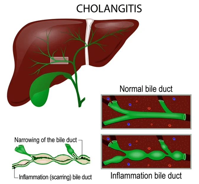 cholangitis_medigest_gastro_liver_and_endoscopy_clinic