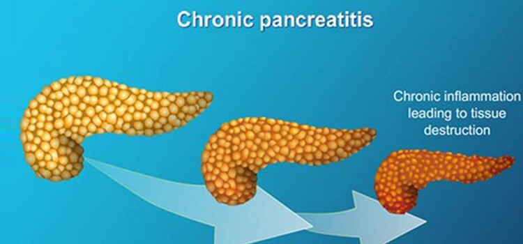 chronic_pancreatitis_endoscopy_services_at_medigest_clinic