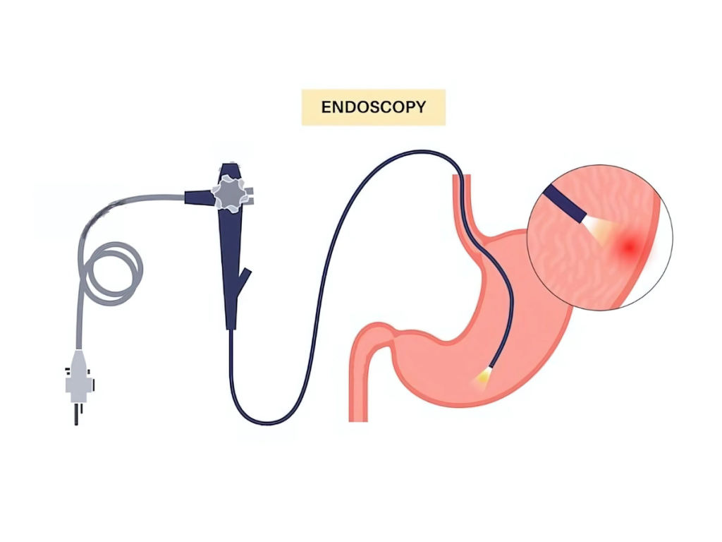 Illustration of endoscopy technology showing an endoscope examining the stomach lining for diagnosis.